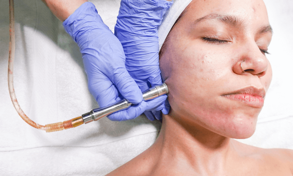 Närbild på microdermabrasion-behandling där hud slipas med diamantspets för jämnare struktur.